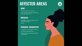 Comparing Skin Issues: Acne vs. Rosacea vs. Dermatitis | Merck Manual