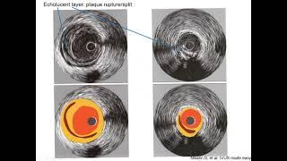 Intravascular ultrasound (IVUS) - Elias Hanna, Univ of Iowa