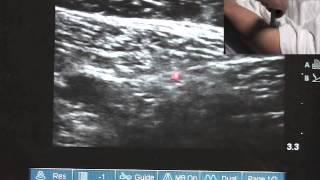 Ultrasound Guided Saphenous Nerve Block - SSRAUSA.com