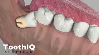 Impacted Tooth Removal