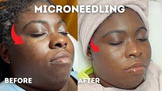 Microneedling Acne Scars | Before and After | Glam By Lia Leigh