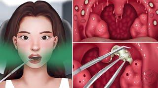 ASMR  Throat Tonsil Treatment and Stone Removal Animation  Bad Breath and White Tongue Cure