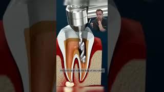 What is root canal treatment?  #dentist #toothbrush #brushingteeth #bracestreatmentinindore