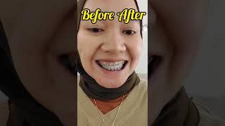 Before After Braces Rubber