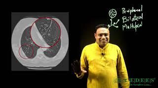 Understanding CORADS and CT Severity Score in COVID-19 the easy way!!