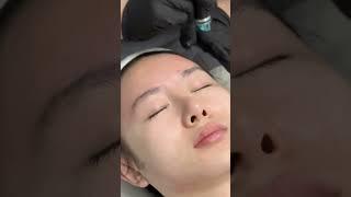 Hydra Facial Treatment at Pure Cell New Life Solutions in Pasadena California