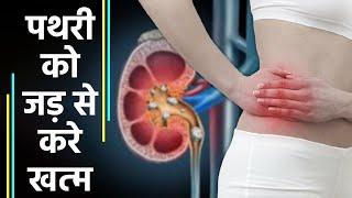 पथरी को जड़ से खत्म करेगा ये चीज |  Kidney Stone treatment । Boldsky