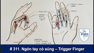 #311. Ngón tay bị kẹt (ngón tay cò súng) - Trigger Finger