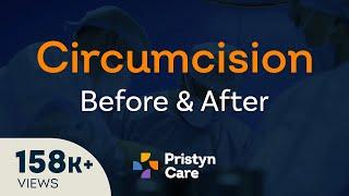 Before v/s After Laser Circumcision Surgery - For FREE Consultation Call On 6366526482