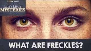 What are Freckles?