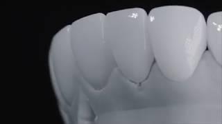 SEVIL PEARLY OFF SCALE WHITE® FULL VENEERS