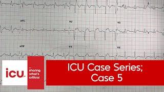 ICU Case series - ICUcase 5 (cardiology, qRBBB in ACS, ? importance)