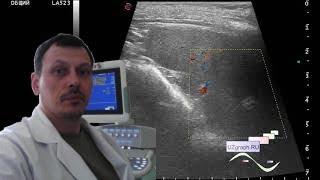 Pediatric Abdominal ultrasound - Spleen lesion
