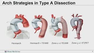 Zone 2 Arch with Sequential TEVAR Is Best: Nimesh Desai, MD, PhD