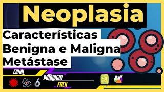 Neoplasias Benignas e Malignas - Características ; Metástase (Patologia Geral) [Atualizado 2022]