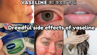 Dreadful side effects of Vaseline|don't use before watch,खुद को खराब न करे,right use to vaseline