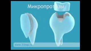 Зубные протезы. Виды зубных протезов и их особенности