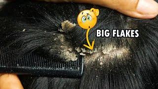 Dandruff Scratching Big Flakes!!! Dandruff Removal Satisfying #289