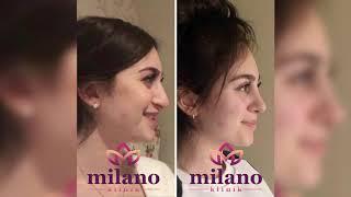 RHINOPLASTY SURGERY (Nose Job) and FEATURES | Milano Clinic Turkey