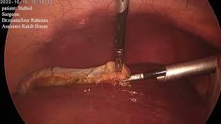 laparoscopic cholecystectomy | Dr.Mustafizur Rahman