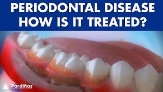 Periodontitis and its influence on health - How is periodontal disease treated? ©