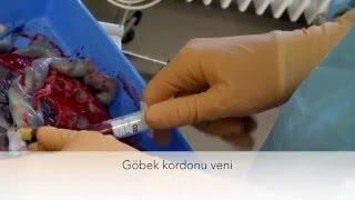 Göbek kordonundan kan alma tekniği - Nabelschnurblutentnahme