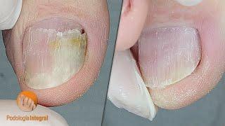 Toenail recovery | Medial lysis | Podological goal achieved! [Podología Integral]