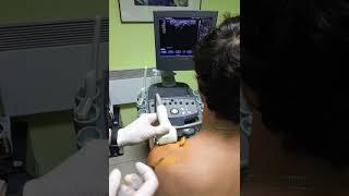 PRP injections with ultrasound control