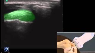 How To: Shoulder Ultrasound-Guided Injection of the AC Joint 3D Video