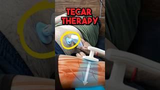 TECAR THERAPY for Pain | #physiotherapy #aprc