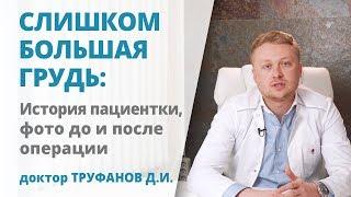 Уменьшение очень большой груди: невероятный результат операции