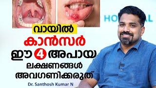 വായിൽ കാൻസർ ഈ 4 രോഗ ലക്ഷണങ്ങൾ അവഗണിക്കരുത് | Oral Cancer | Dr. Santhosh Kumar