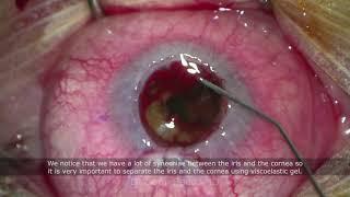 Ocular Trauma Following Corneal Graft Surgery - Dr Sami A. Saad