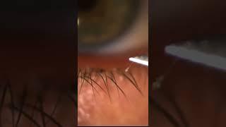 Eyelid Mite Infestation:  Demodex