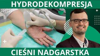 Hydrodekompresja cieśni nadgarstka - nieoperacyjna metoda leczenia - lek. Tomasz Grądzki