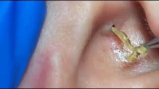 TOP OF BLACKHEADS REMOVAL FROM THE EAR  #2 #relaxing  #blackheads