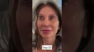 6-Week Facelift Healing & Recovery Progression!