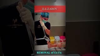 Removal of illizarov with wire cutter