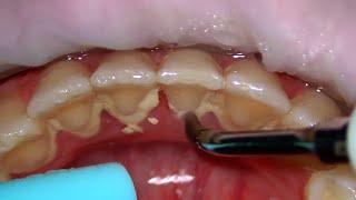 Teeth Cleaning {DEEP CLEAN} #shorts