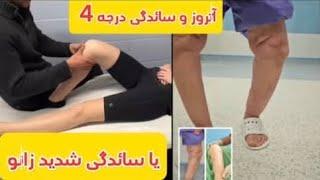 چگونه بفهمیم آرتروز ( ساییدگی زانو ) داریم؟ | How to diagnose knee OA |