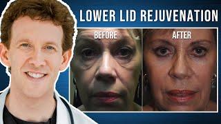 Laser Skin Resurfacing with Dr. Adam Scheiner | Jennifer's 5 Year Update