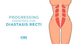 Progressing Exercises for Diastasis Recti