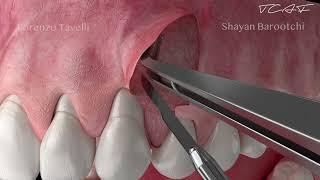 Dental Animation - The Tunneled Coronally Advanced Flap (TCAF)