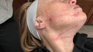 Neck Lifting Treatment Using V Soft Lift Lifting ARTE PDO Threads