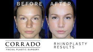 Beautiful Nose Job Results Revealed 3 Months After Surgery | Dr. Anthony Corrado