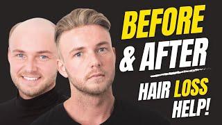 How to Apply (Attach) a Non-Surgical Hair Replacement System for Men with The Harris Brothers UK/USA