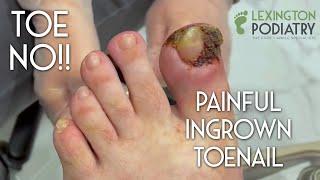 TOE NO!! Painful Ingrown Toenail Removal