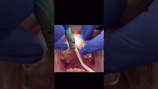 Dental Implant Guided Surgery: Smarter, Faster, Better #shorts #cosmeticdentistry  #implantdentistry