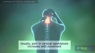 Cervical Spondylosis. Symptoms