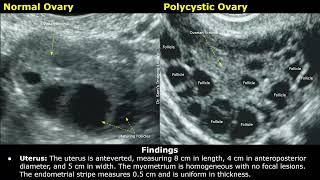 Polycystic Ovarian Syndrome (PCOS) Ultrasound Report Example | How To Write Gynecological USG Report